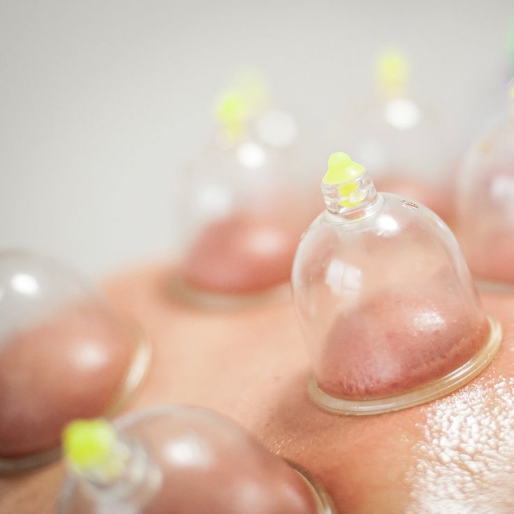 dry cupping